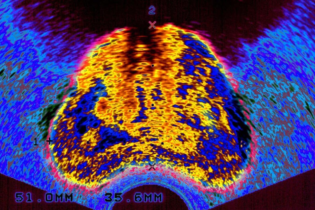 We are finally improving prostate cancer diagnoses – here’s how