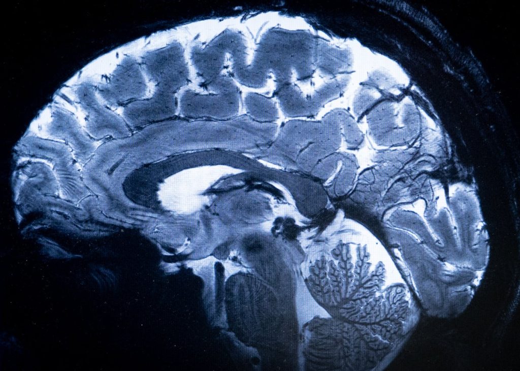 Brain Structure That Filters Consciousness Identified