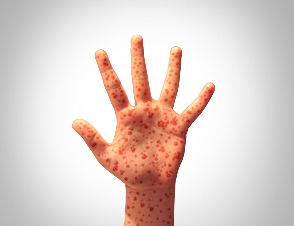 Do ‘Alternative’ Measles Treatments Touted by RFK Jr. Work?